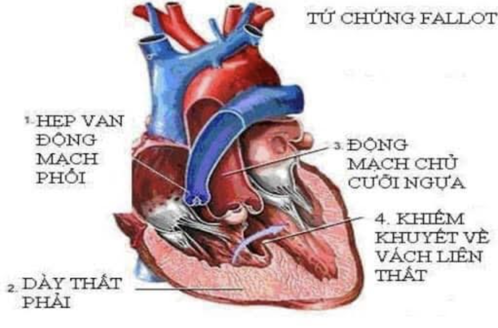 Mẹ đi khắp nơi tìm 600 triệu đồng cứu con gái mắc bệnh hiểm phải sửa tim - 2