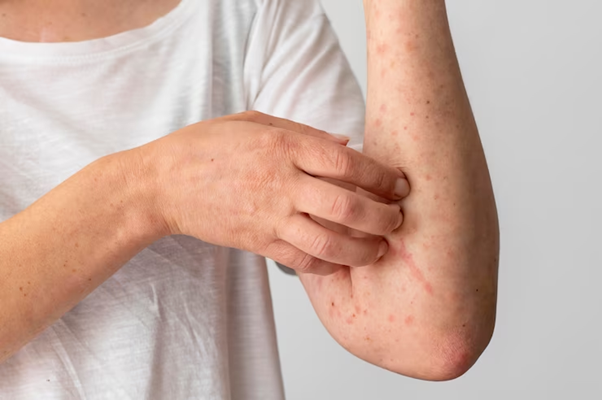 Nổi mề đay, mẩn đỏ có thể là dấu hiệu chức năng gan suy giảm - 1
