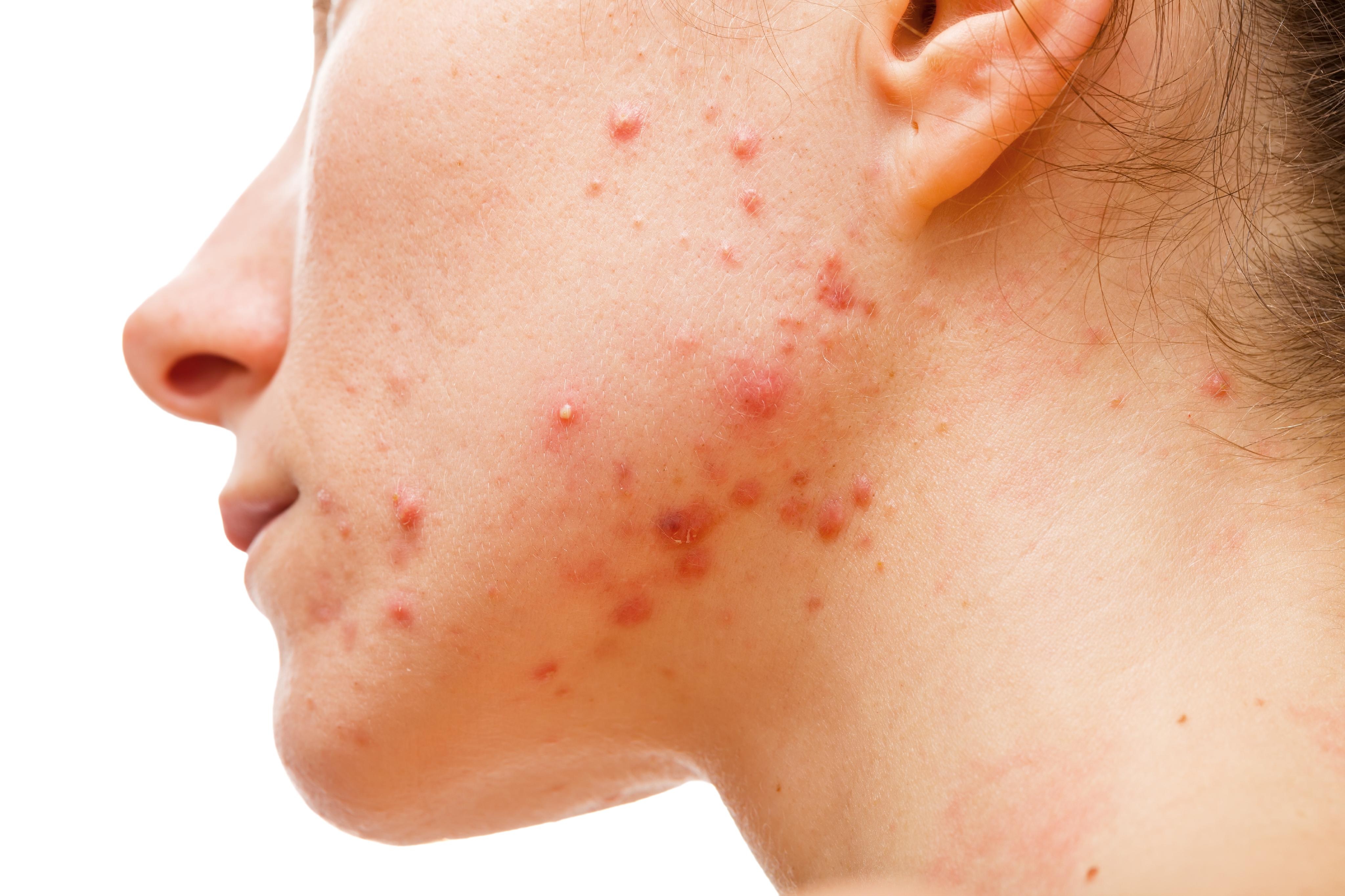 Bác sĩ da liễu mách bạn cách thoát khỏi mụn trứng cá - 1