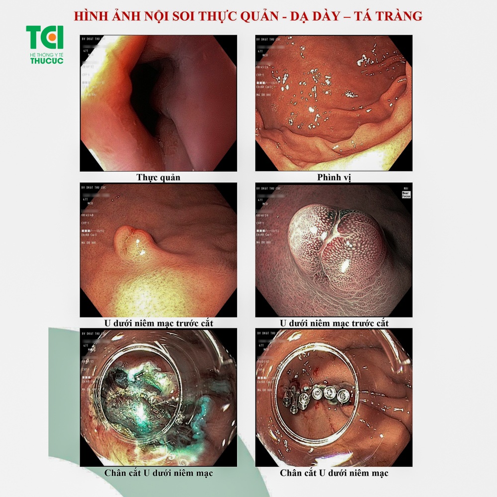 Cắt toàn bộ khối u dưới niêm mạc dạ dày không mổ mở, không đau - 3