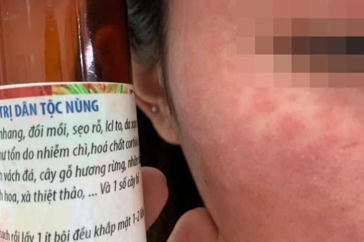 Hà Nội: Mê lột da làm đẹp, thiếu nữ nhận lại làn da rắn - 1