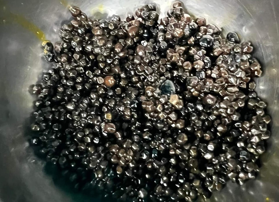 Cụ bà có hàng nghìn viên sỏi trong túi mật - 1