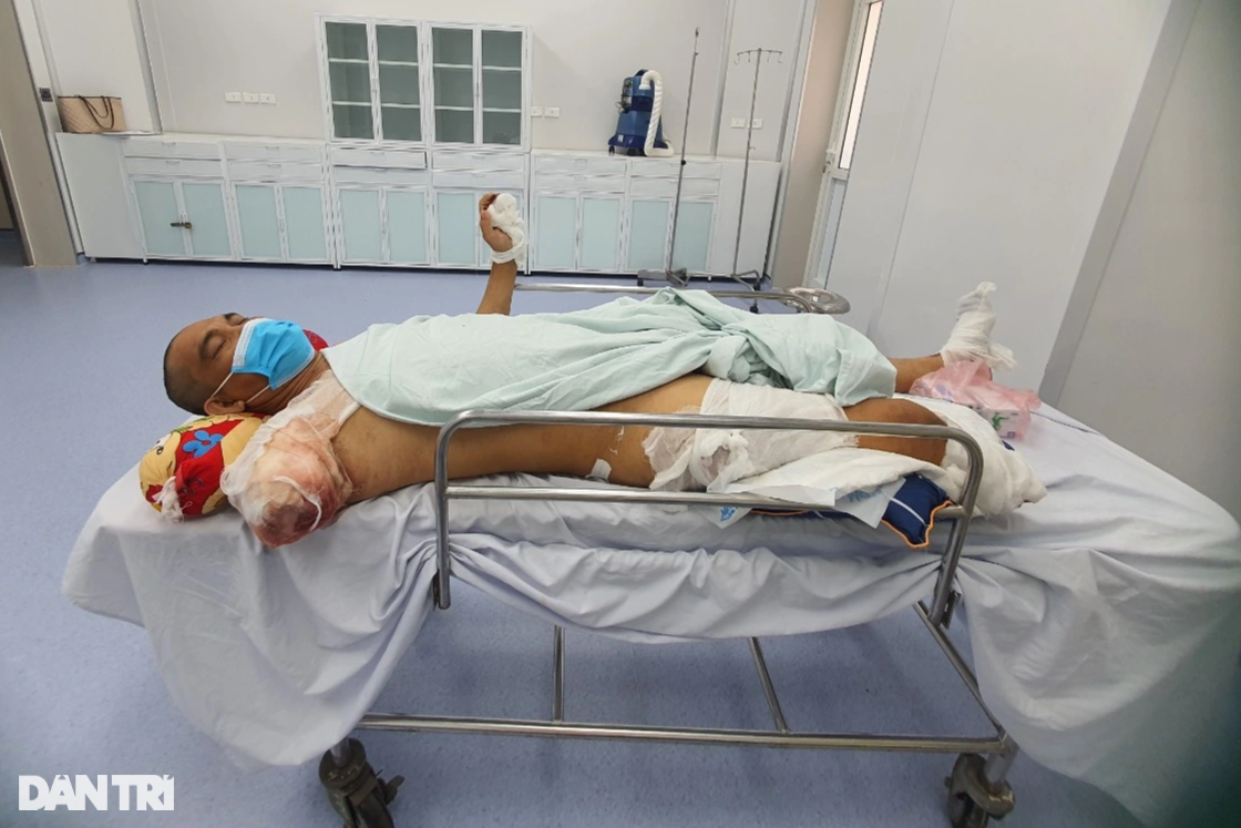 View - Bỏng điện cao thế, người đàn ông trụ cột gia đình phải cắt cụt tay, chân | Báo Dân trí