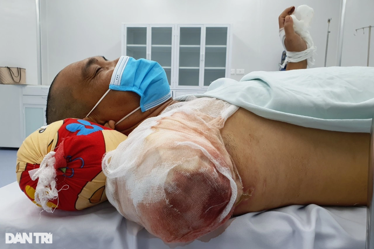 View - Bỏng điện cao thế, người đàn ông trụ cột gia đình phải cắt cụt tay, chân | Báo Dân trí