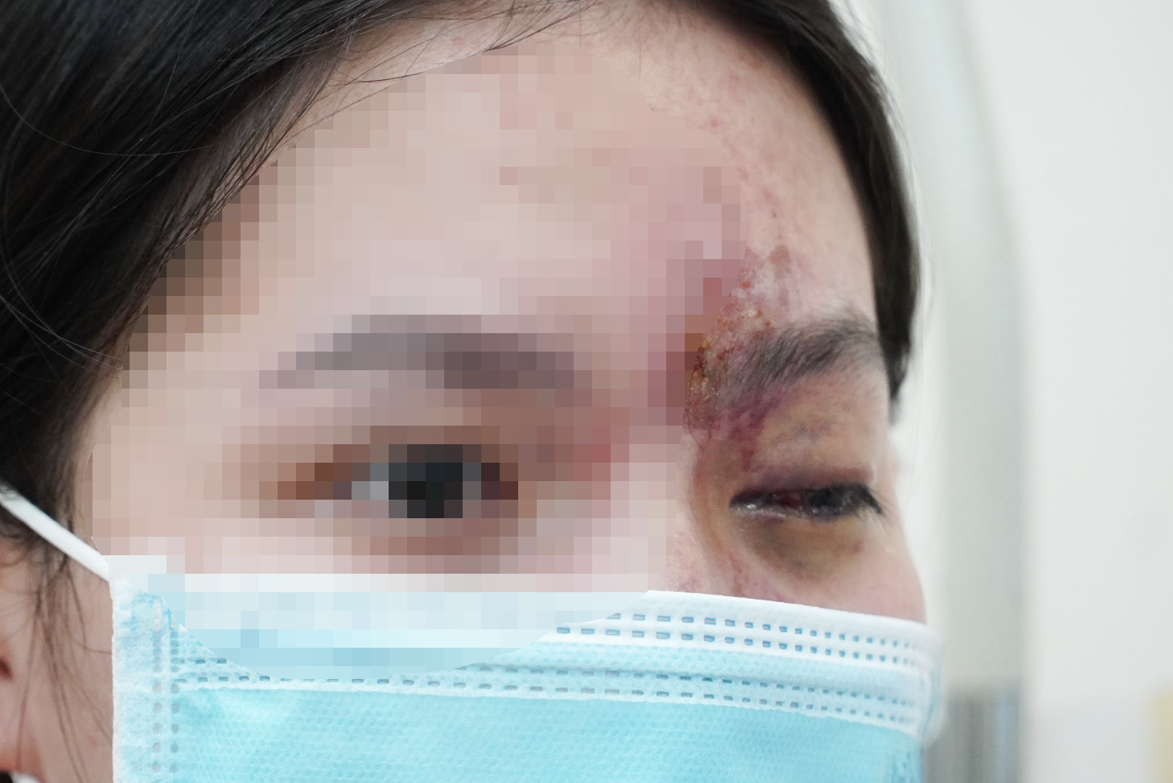 Tiêm filler có thể gây mù vĩnh viễn, bác sĩ nêu nguyên nhân phổ biến