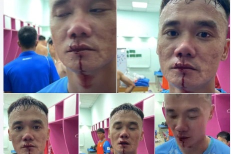 Cầu thủ đội hạng Nhất tố bị đánh chảy máu bên trong sân Thống Nhất