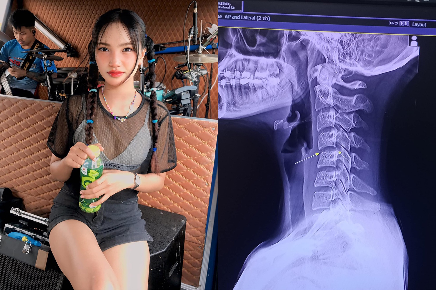 Vụ nữ ca sĩ Thái Lan qua đời: Chưa thể khẳng định do massage cổ