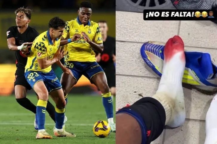 Lamine Yamal khoe bàn chân đẫm máu, Barcelona vô cùng lo lắng