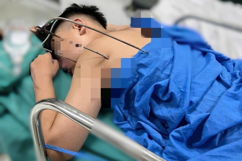 Dị vật 3 càng đâm thấu tim nam thanh niên 17 tuổi ở Hà Nội