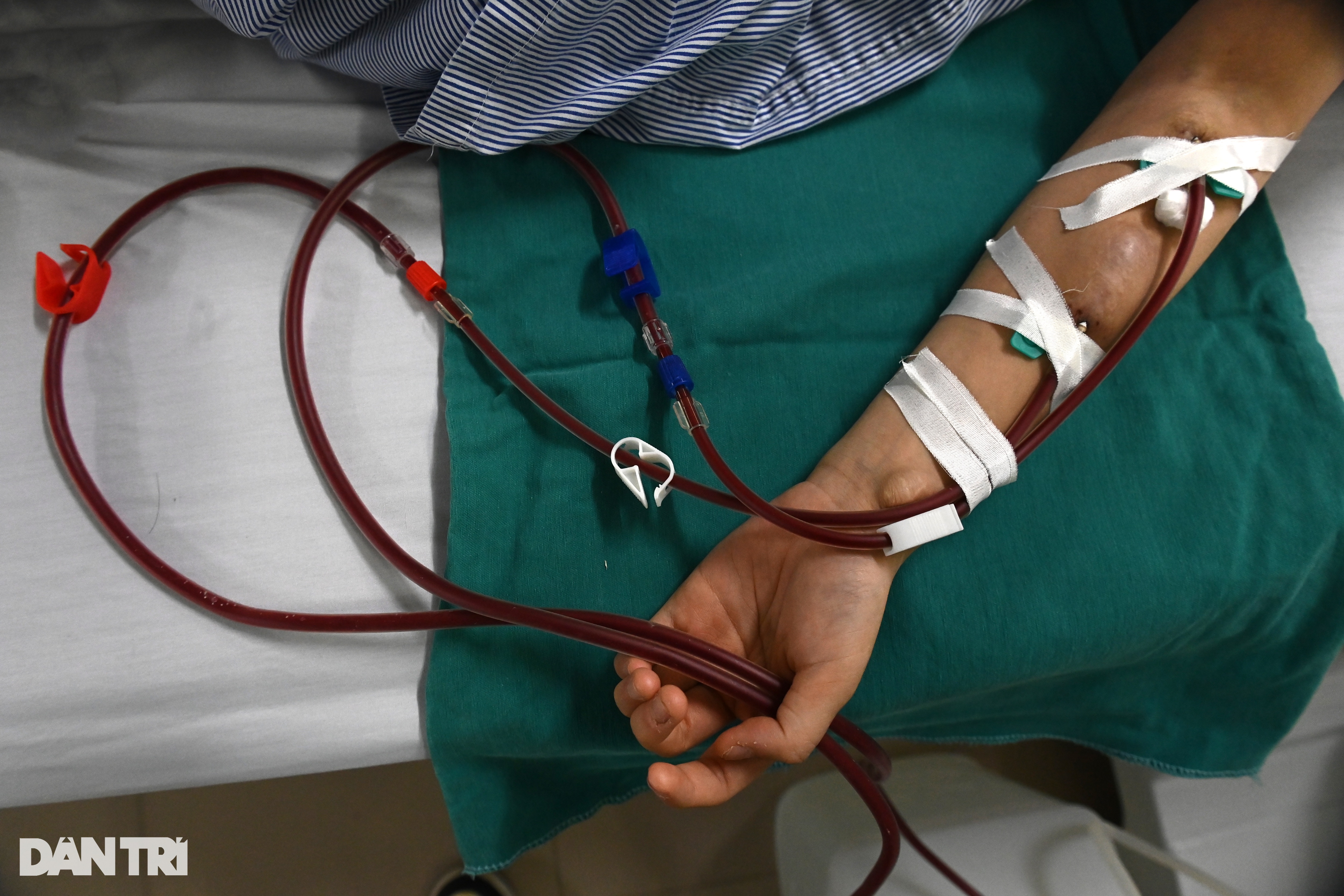 Suy thận ở tuổi 25 sau 5 năm thường xuyên thức khuya, ăn đồ ăn nhanh