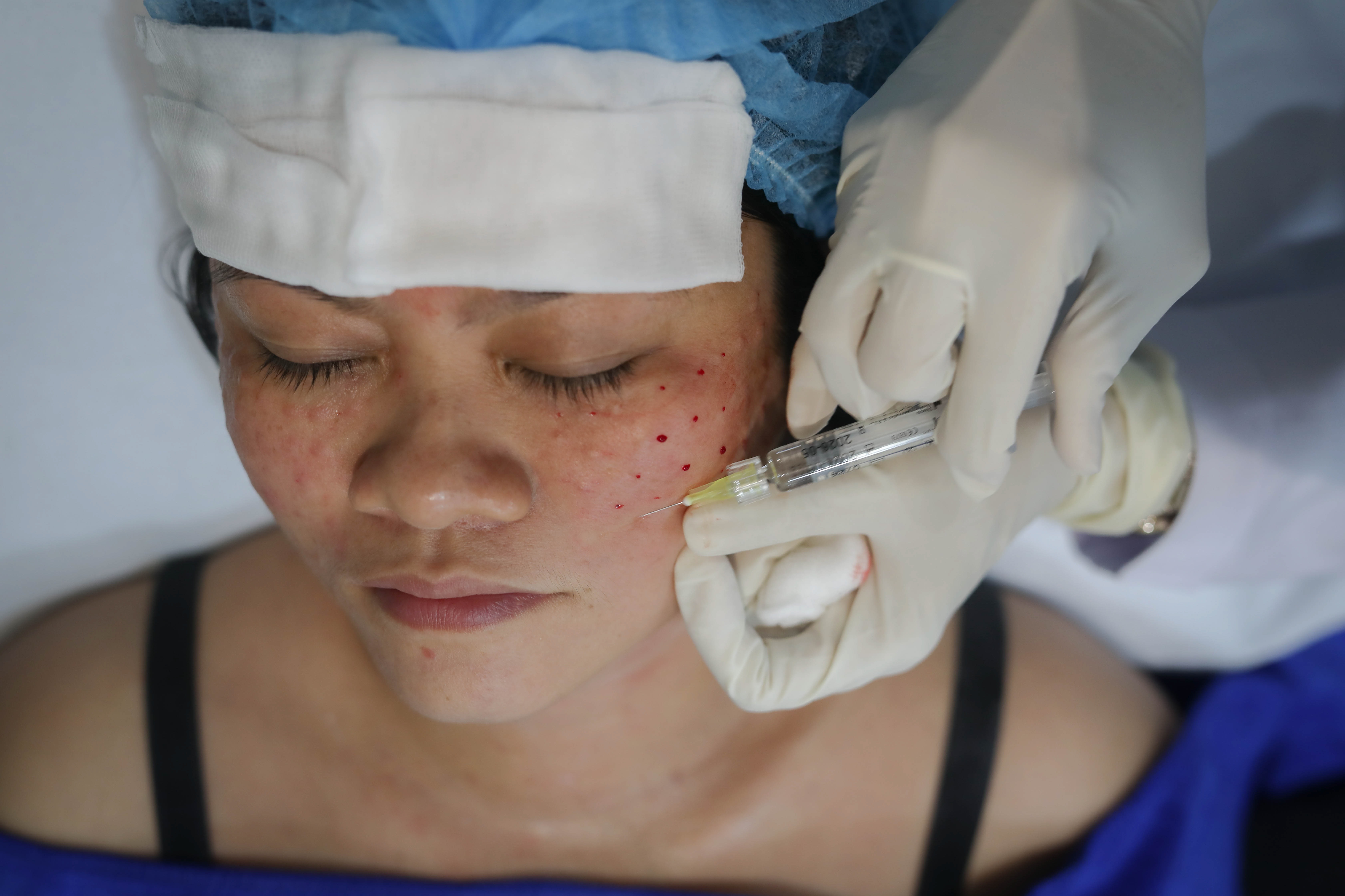 Biến chứng thẩm mỹ gần Tết tăng 20%, bác sĩ lên tiếng cảnh báo