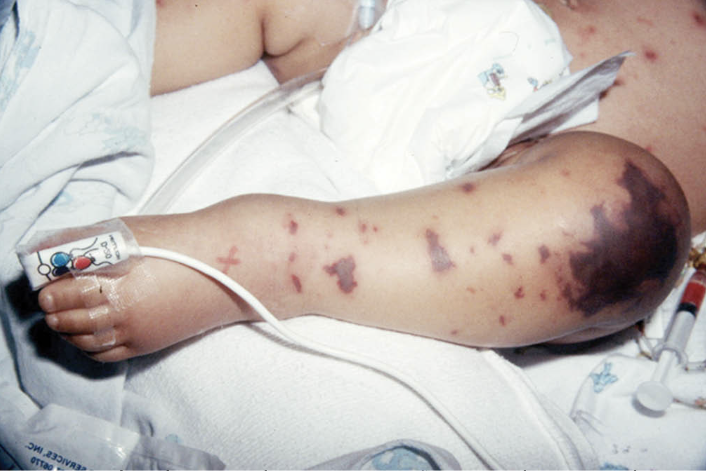 Bé gái ở Phú Quốc tử vong sau mắc não mô cầu: Chuyên gia nhi khoa nói gì?