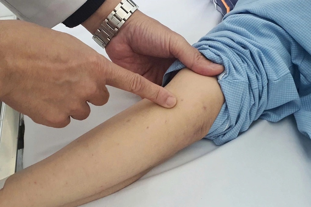Chùm 4 ca não mô cầu tại TPHCM: Lập danh sách người tiếp xúc gần