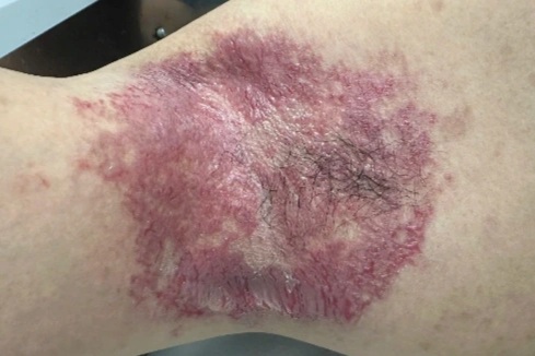 Bác sĩ Việt Nam chữa khỏi bệnh da di truyền hiếm gặp nhờ tiêm botox