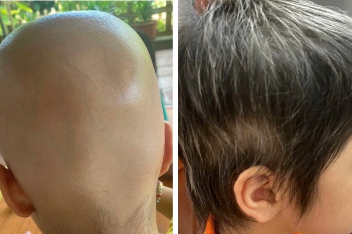 Nhiều người trẻ bỗng dưng rụng tóc trơ trọi