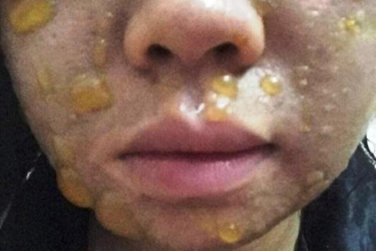 Nhiều người nhập viện vì mặt sưng húp, sạm đen sau peel da theo mạng xã hội