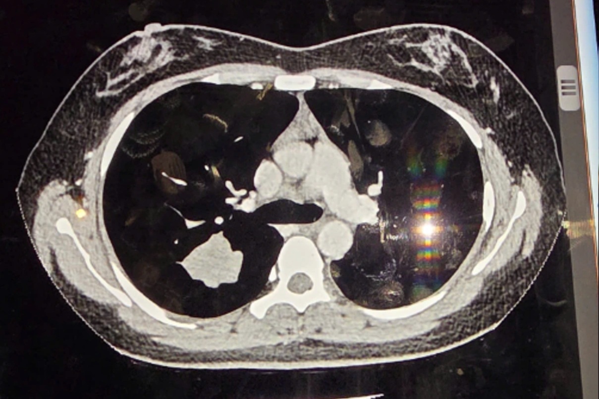Cô gái 29 tuổi, không hút thuốc, bàng hoàng phát hiện mắc ung thư phổi