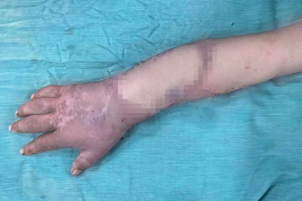 Thai phụ được ghép tạm tay đứt lìa vào chân đã thực hiện ca mổ "định mệnh"