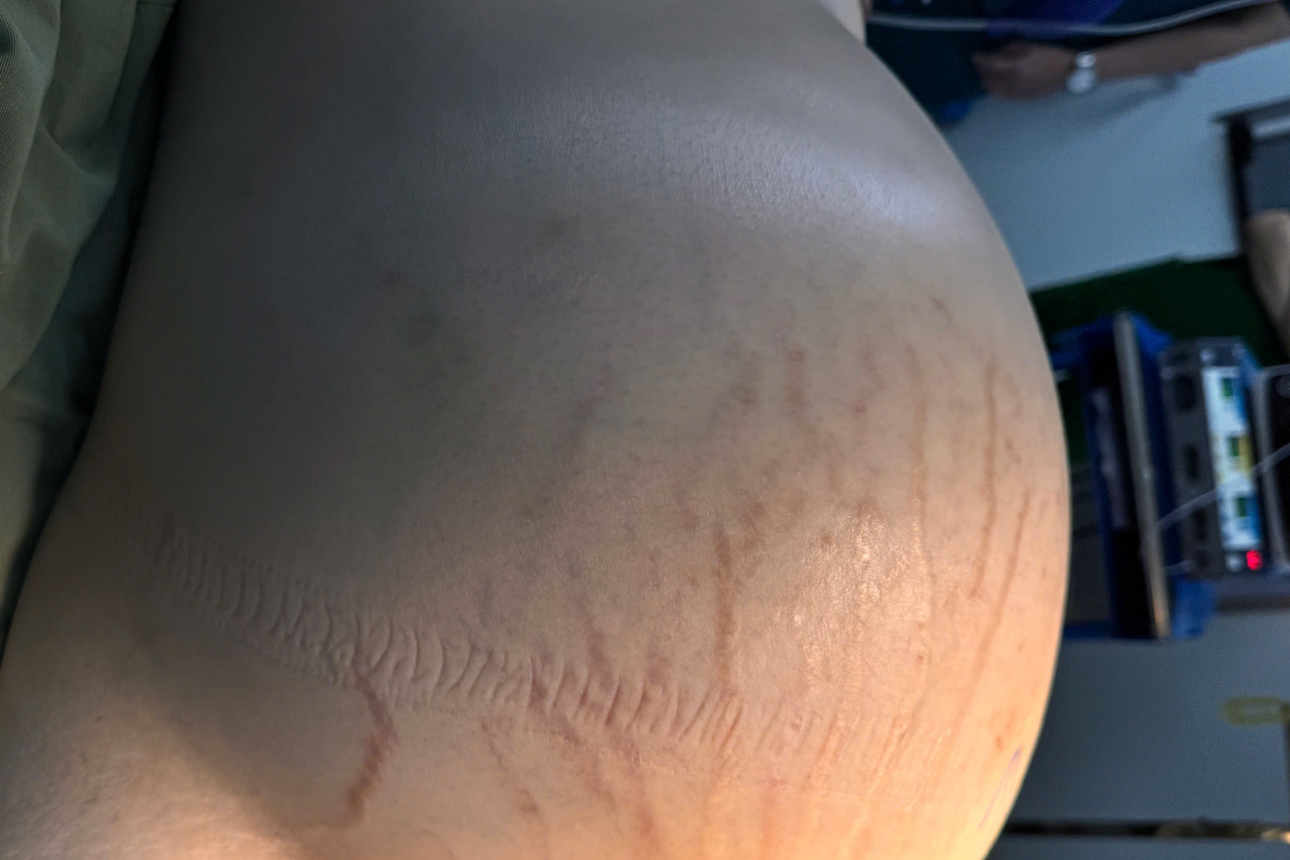 TPHCM: Cô gái che giấu bụng to vì sợ hiểu lầm, khối ung thư phát triển 15kg