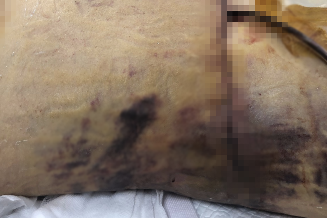 Nữ Việt kiều 60 tuổi tử vong vì biến chứng nặng sau khi hút mỡ, nâng ngực