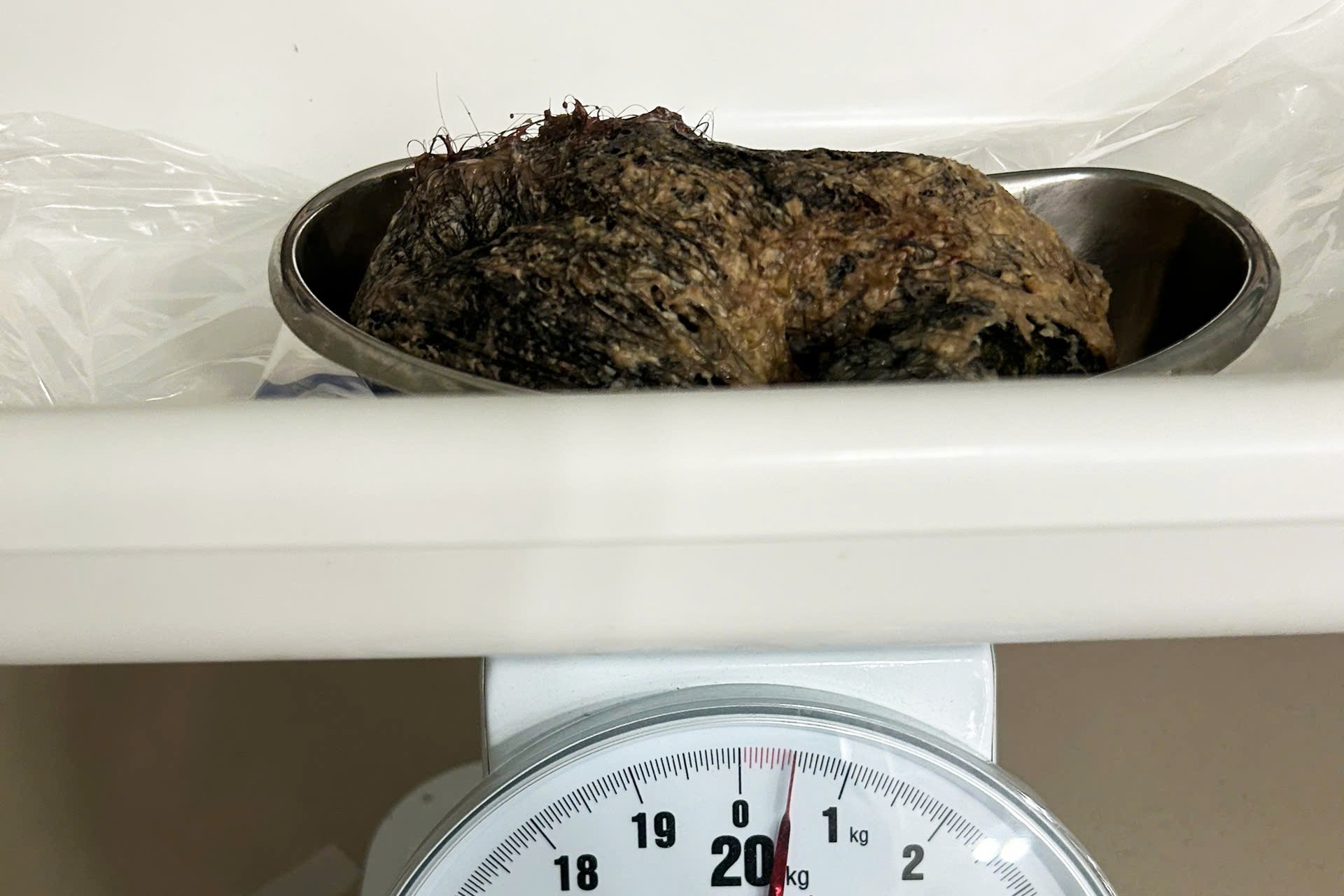 Bé gái 6 tuổi ăn nửa cân tóc