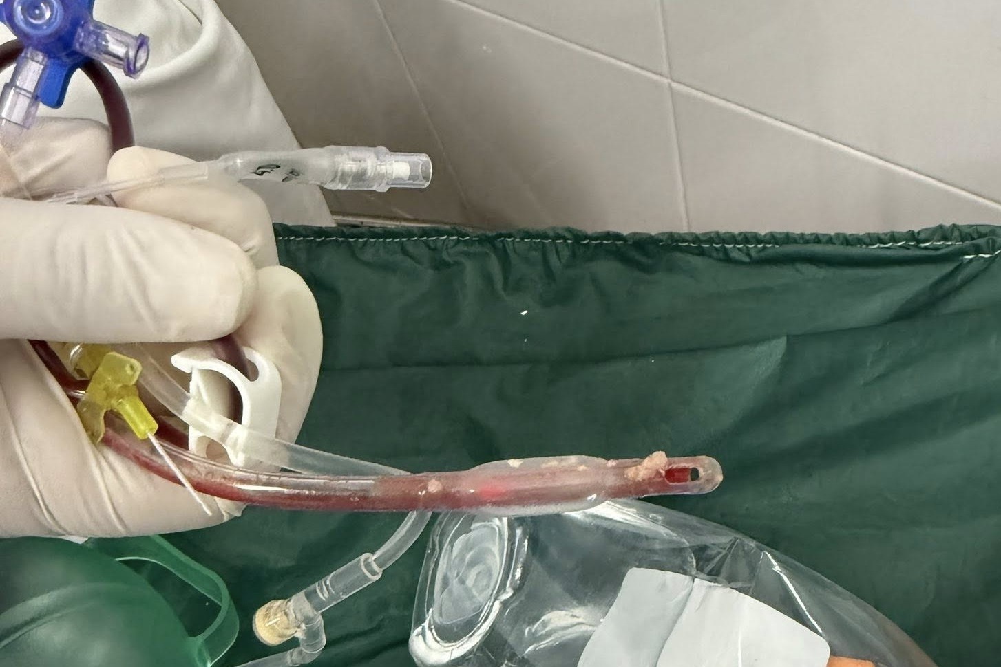 TPHCM: Ho sặc khi ăn ở nhà trẻ, bé gái 3 tuổi tử vong thương tâm