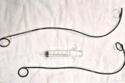 Lấy 2 ống thông điều trị tiết niệu bỏ quên trong người đàn ông hơn 10 năm