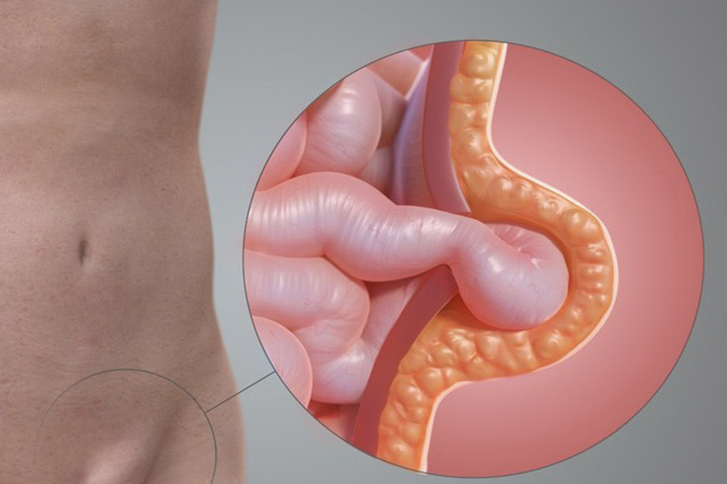 Căn bệnh ở vùng kín khiến người đàn ông suýt hoại tử