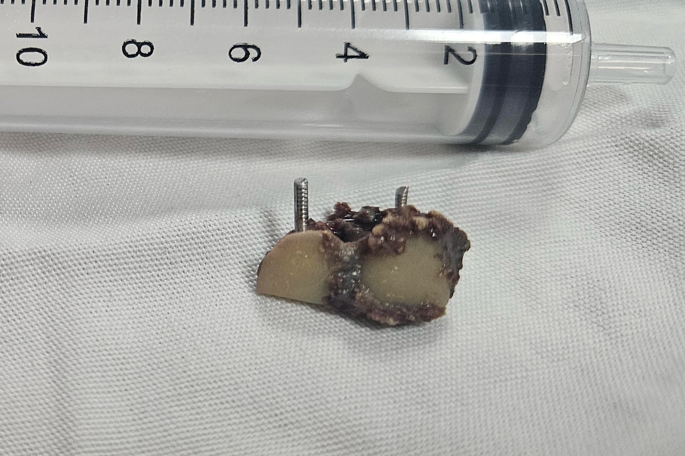 Ho kéo dài, đi khám phát hiện 2 răng giả mắc trong phổi suốt 20 năm