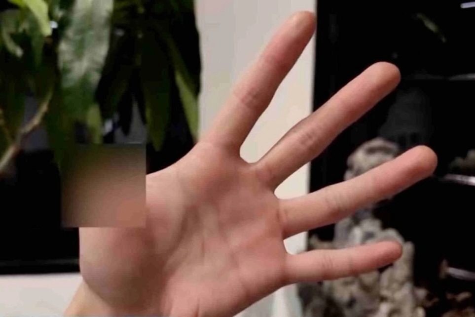 Nuôi rắn độc làm thú cưng, người đàn ông Trung Quốc phải cắt bỏ ngón tay