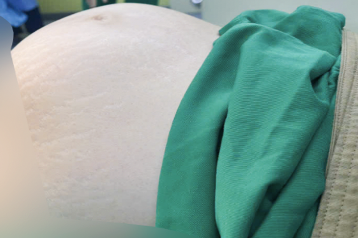 Phát hiện u xơ nhưng không khám định kỳ, người phụ nữ phải cắt bỏ tử cung