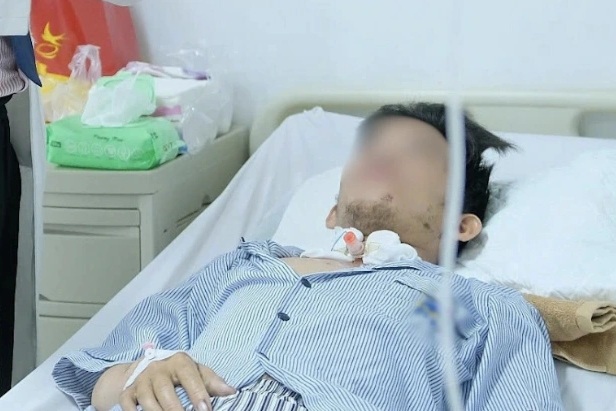 Chàng trai 28 tuổi bị thang máy kẹp chặt cổ, đứt gần lìa vành tai nguy kịch