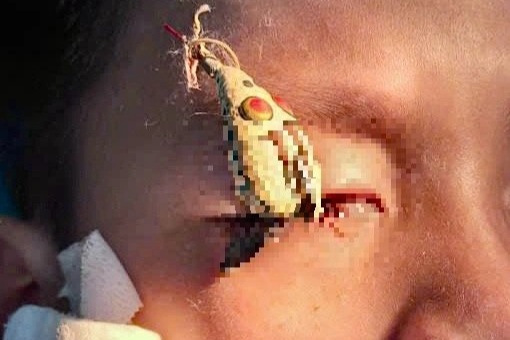 Liên tiếp 2 ca lưỡi câu văng vào mắt, bác sĩ cảnh báo nguy cơ mù lòa