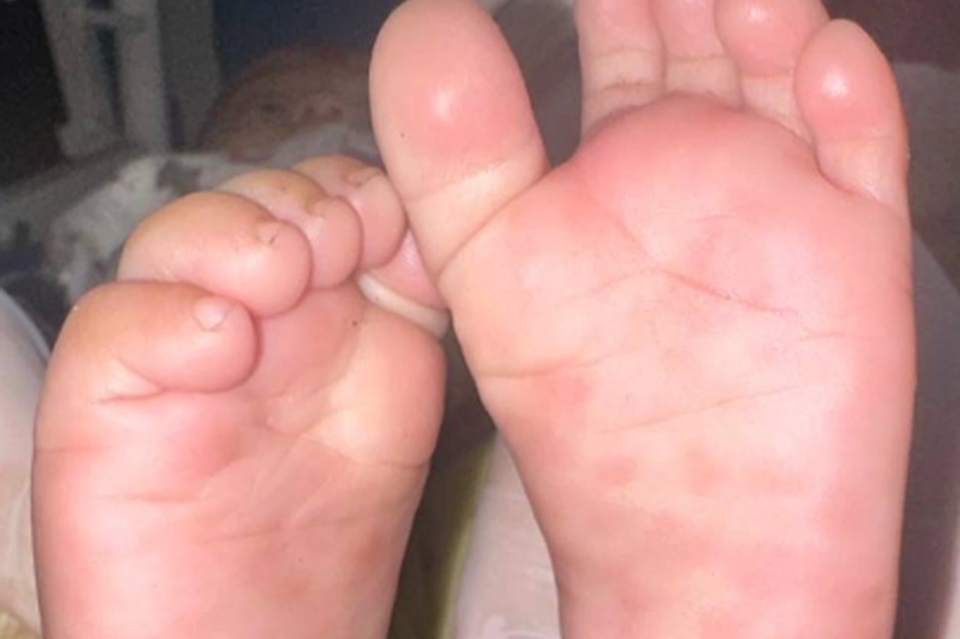 Nhiều ca mắc giang mai, trẻ sơ sinh cũng bị