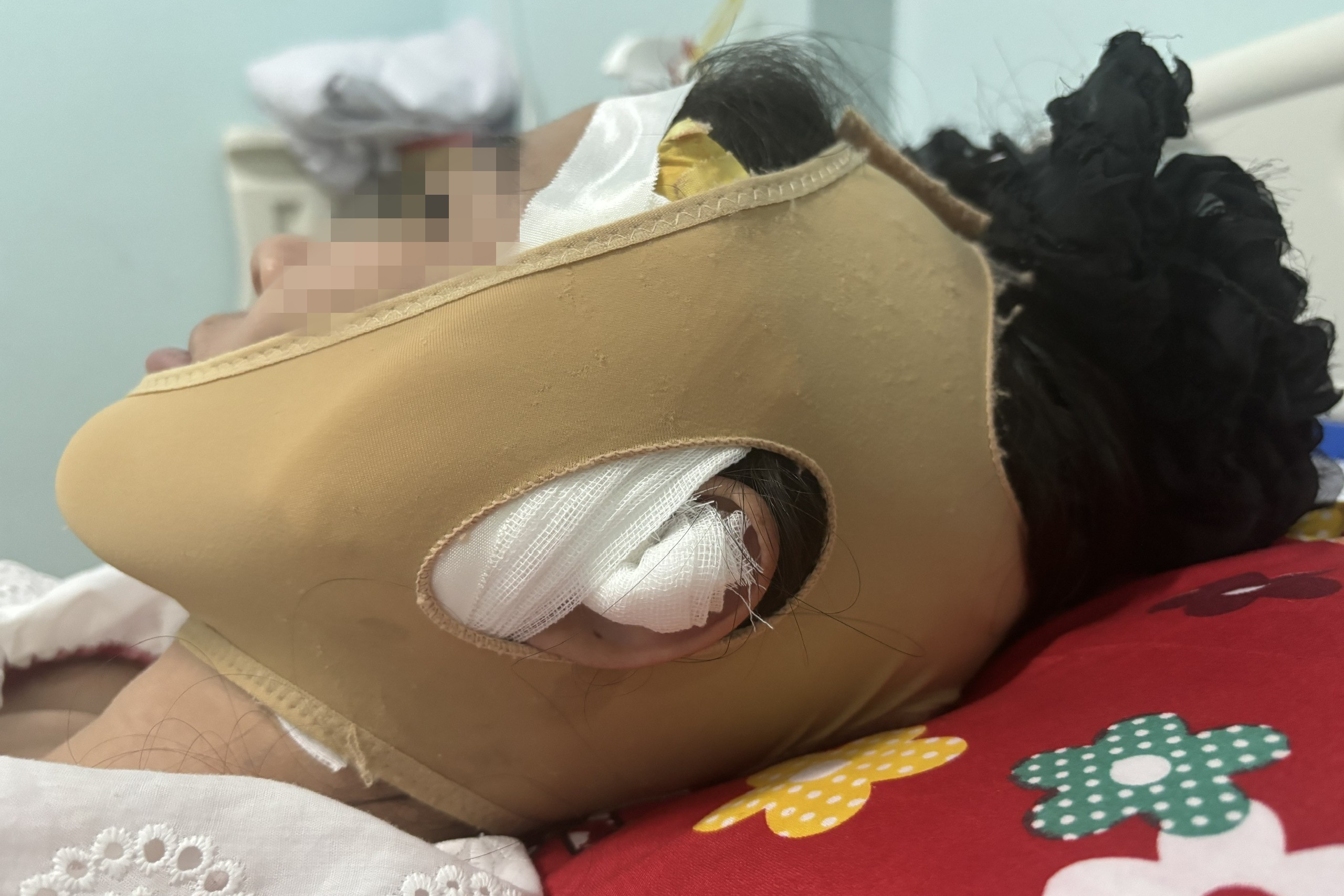 Cô gái biến dạng mặt sau tiêm filler ở TPHCM: "Tôi gọi nhưng spa đóng cửa"