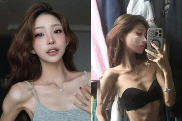 Tình trạng lo ngại của con gái Choi Jin Sil: Từ 100kg chỉ còn da bọc xương