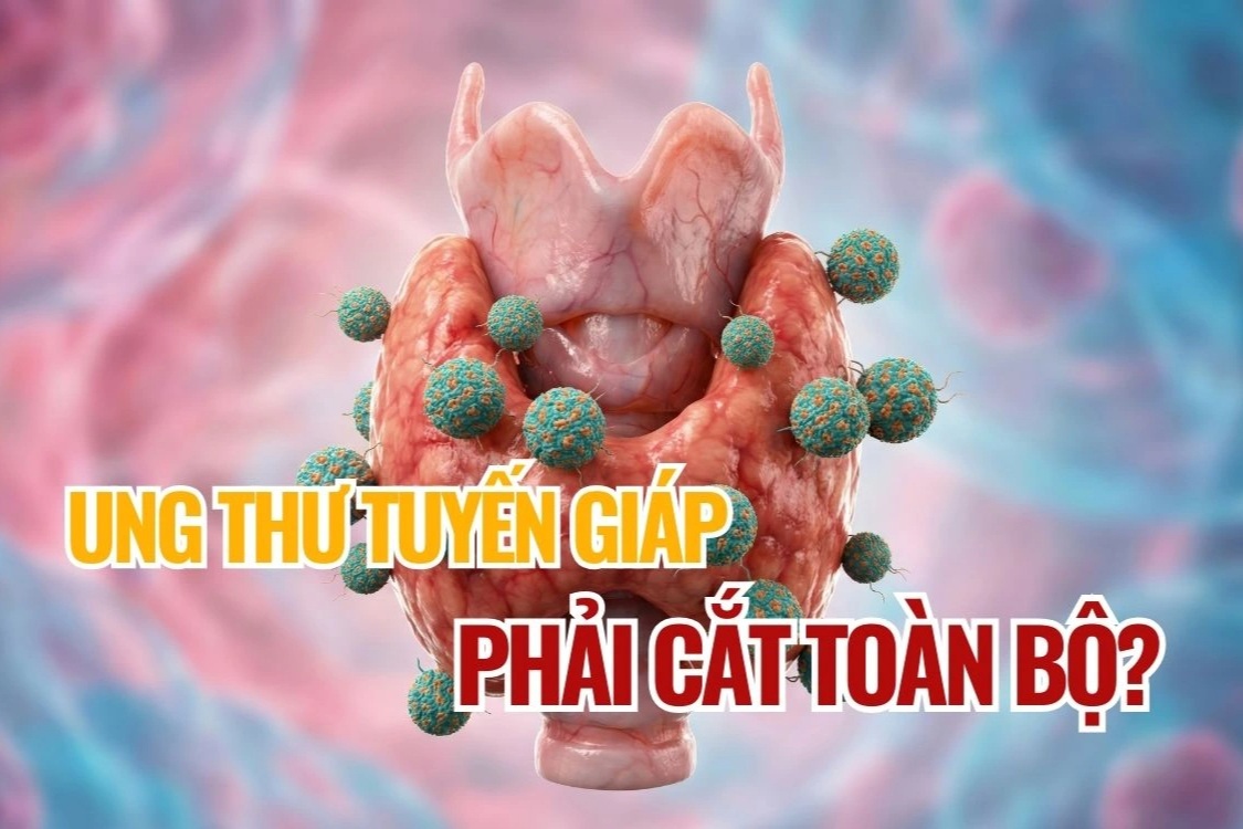 Điều gì quyết định phạm vi phẫu thuật tuyến giáp ở người mắc ung thư?
