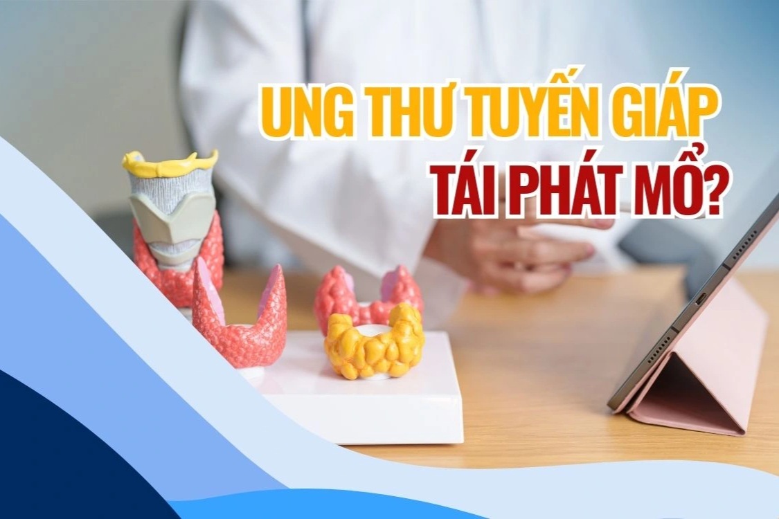 Không chủ quan với nguy cơ tái phát ung thư tuyến giáp