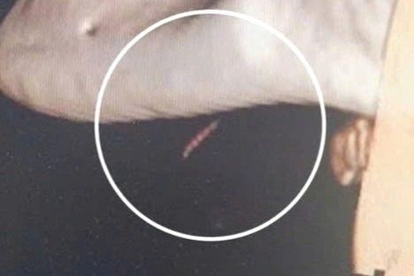 Phẫu thuật lấy dị vật "trú ẩn" 10 ngày trong cằm bệnh nhân