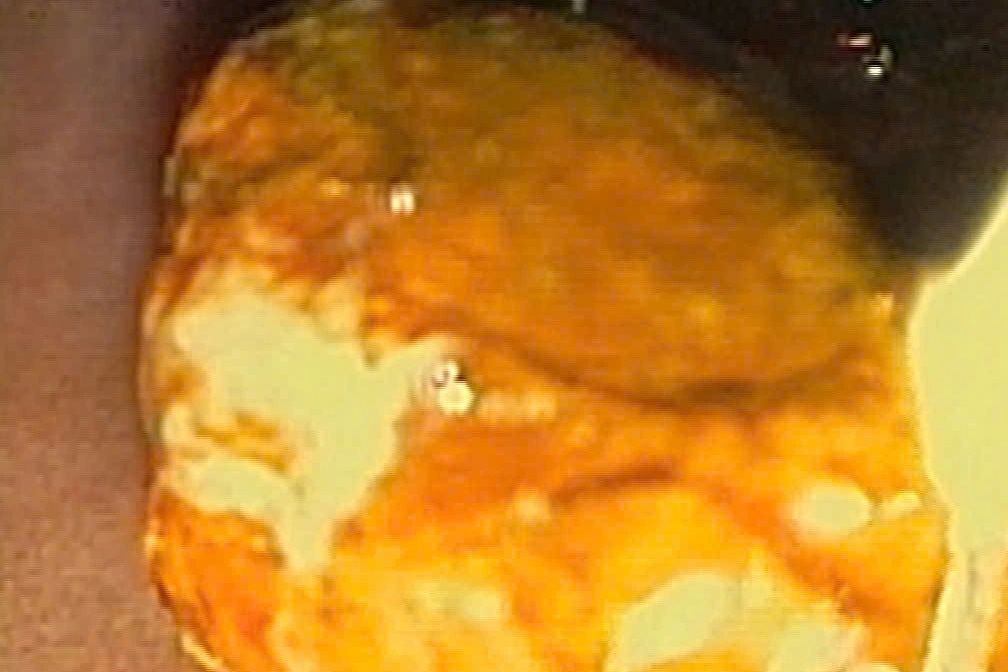 Sỏi mắc kẹt trong đường mật khiến người đàn ông bị vàng da