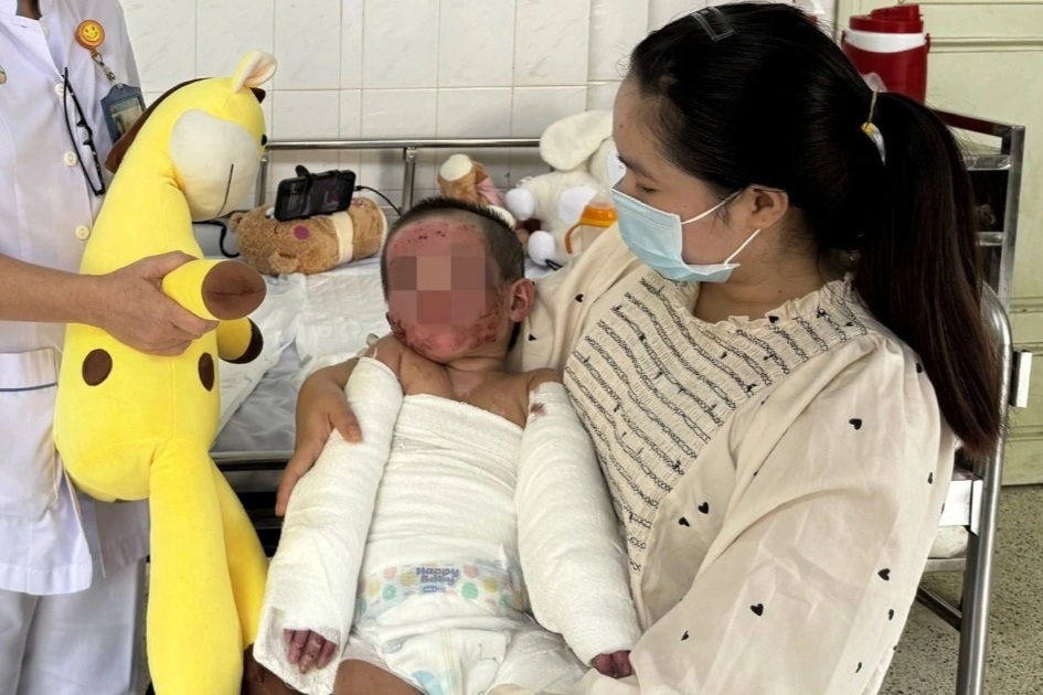 TPHCM: Bé gái bị bỏng 70% cơ thể được cứu sống kỳ diệu, kịp về nhà đón Tết