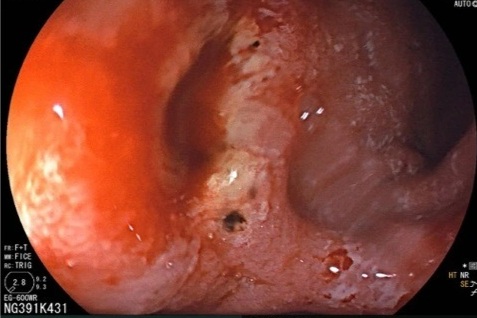 Tháng cuối năm, nhiều người trẻ đi cấp cứu vì xuất huyết dạ dày