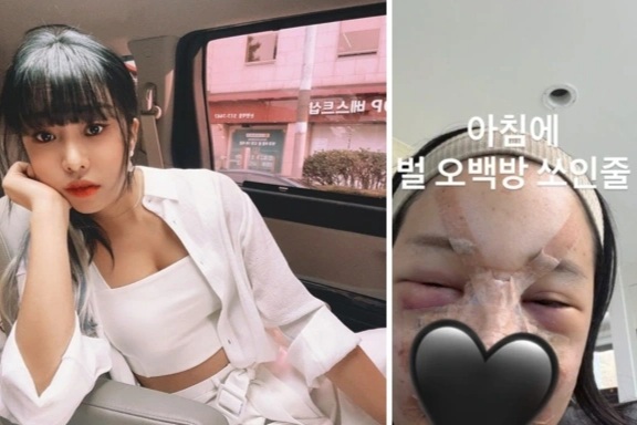 MC xinh đẹp Hàn Quốc bị biến dạng mặt nặng sau phẫu thuật thẩm mỹ cận Tết