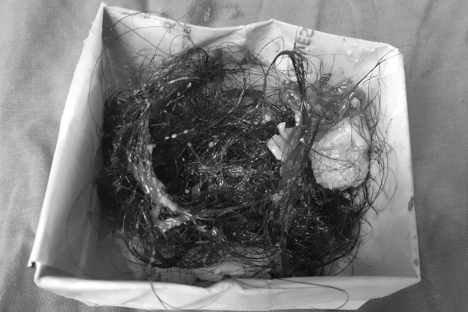 Bóc u nang cho nữ bệnh nhân, bác sĩ phát hiện thành phần kỳ lạ