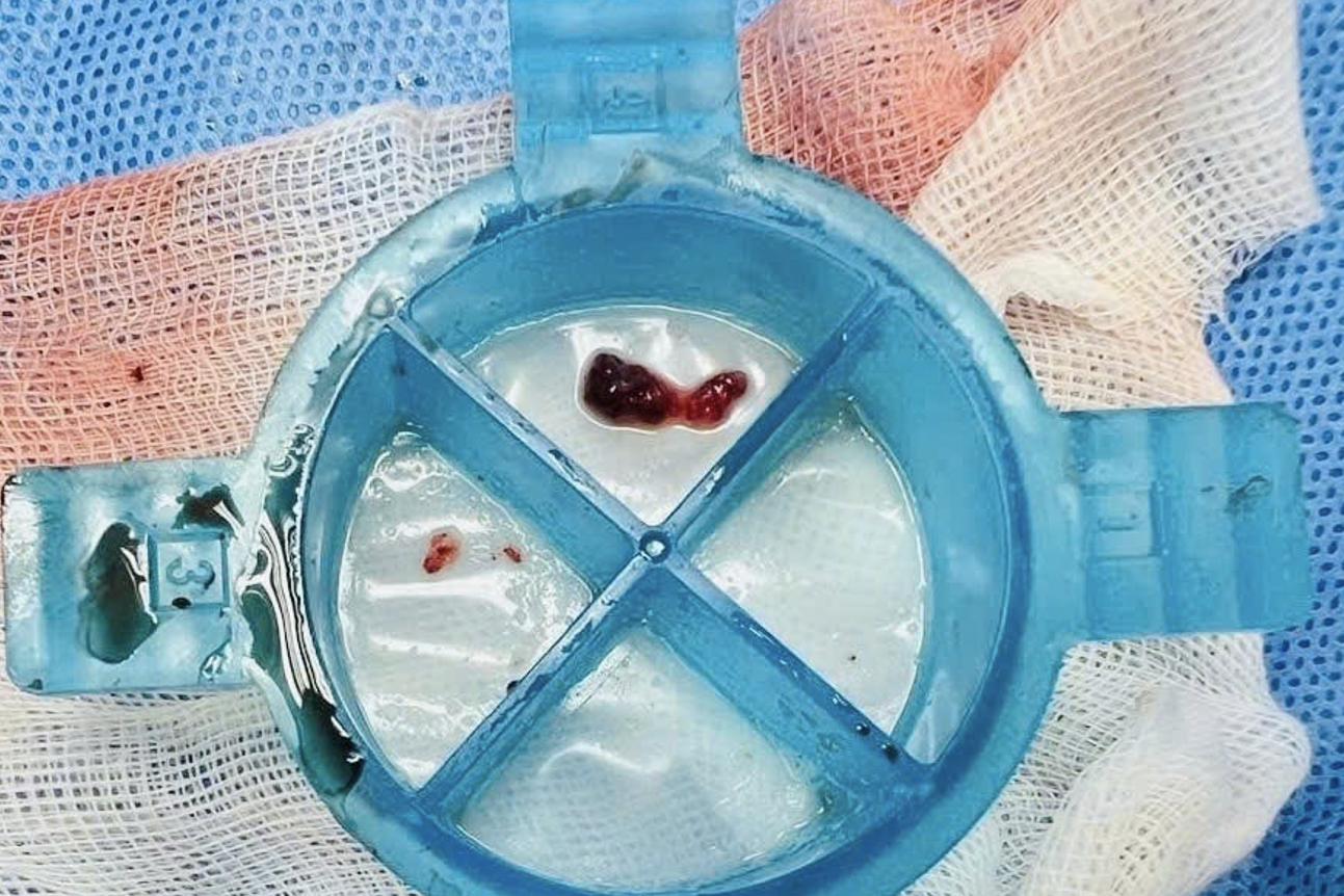 Tình trạng hiếm gặp sau khi bị điện giật khiến người đàn ông nguy kịch