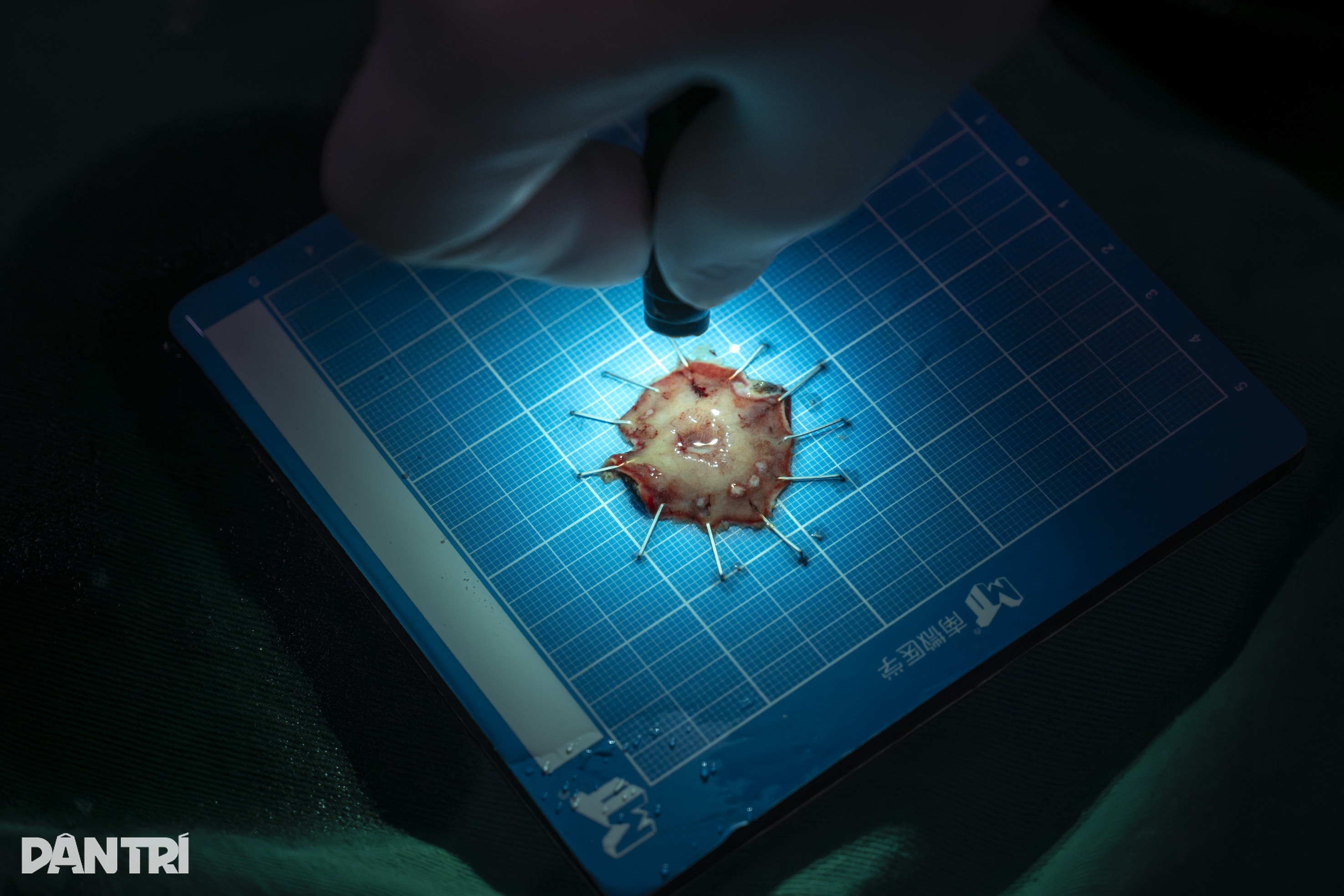 Xem bác sĩ biến ung thư thành "bong bóng", loại bỏ hoàn toàn khỏi dạ dày