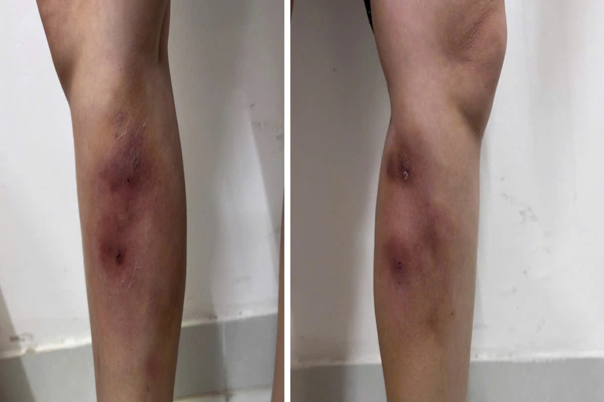 Cô gái gặp họa vì tiêm filler "nắn thẳng chân"