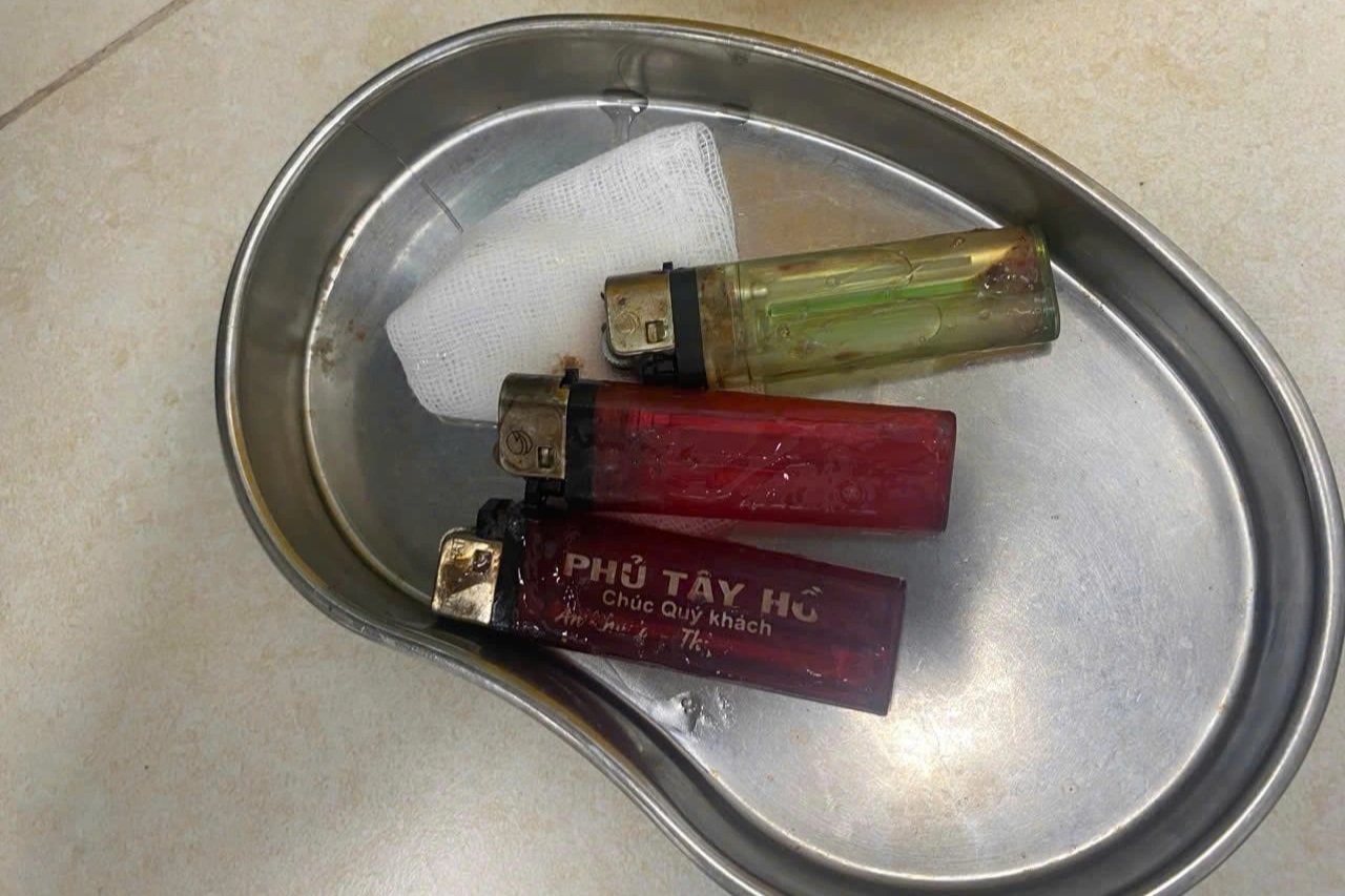 Hy hữu: Bác sĩ gắp được 3 chiếc bật lửa từ bụng bệnh nhân