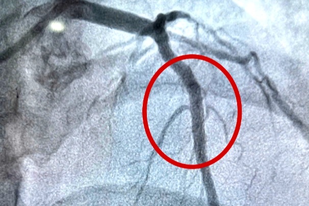 33 tuổi đã tắc nhiều động mạch tim, mạch máu “chằng chịt như rễ cây”