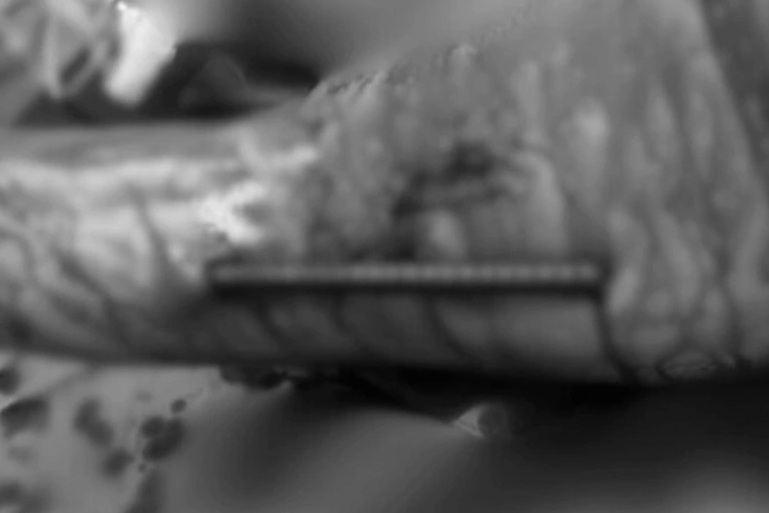 Trượt ngã, nam thanh niên bị thanh sắt dài 30cm đâm xuyên cánh tay